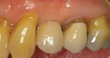Esthetics with implants: Platform switching