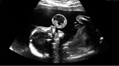 Voor het eerst orale tumor bij foetus verwijderd