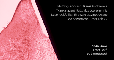 Unikatowa powierzchnia Laser Lok® na implancie i nadbudowie!