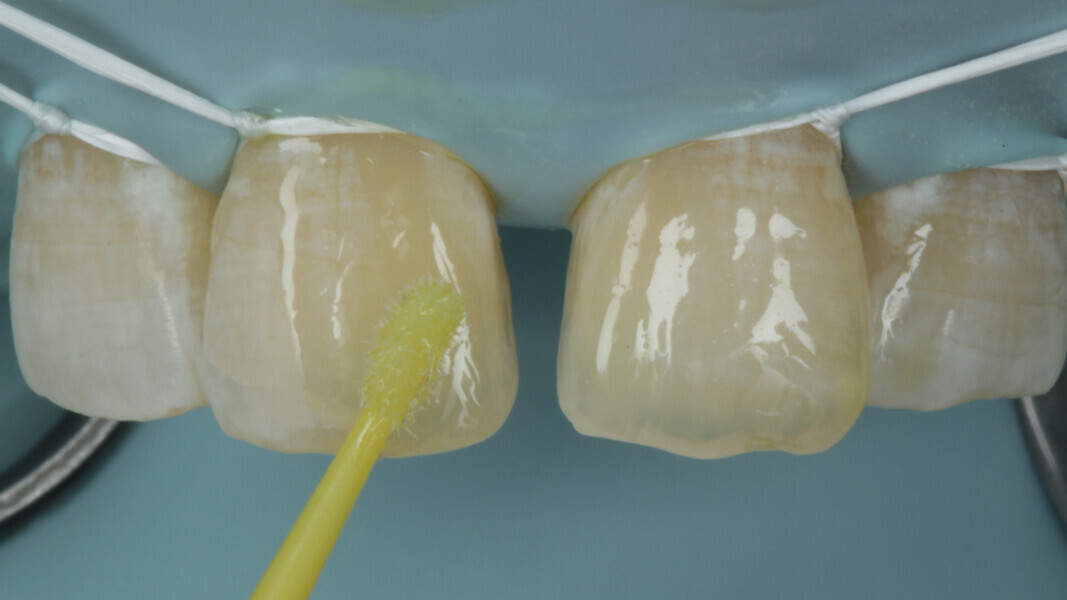 Fig 9. A single Bond Universal from 3M was used as the adhesive. The bond was applied and the excess was removed with a fresh applicator tip and light cured.