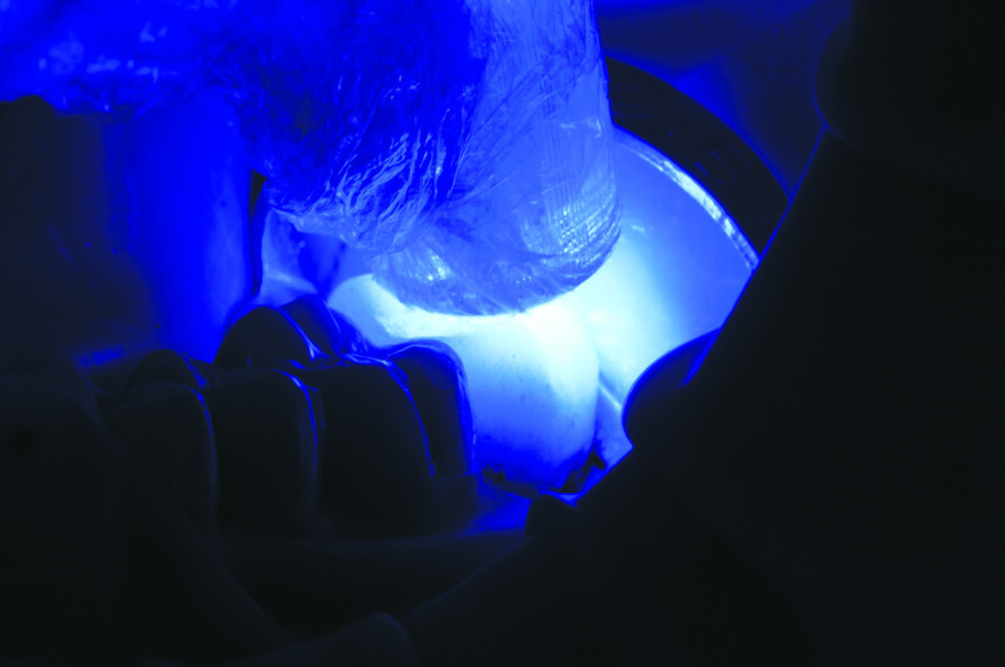 Fig. 14: Light cure for 20 seconds per surface. Finish and polish as needed.