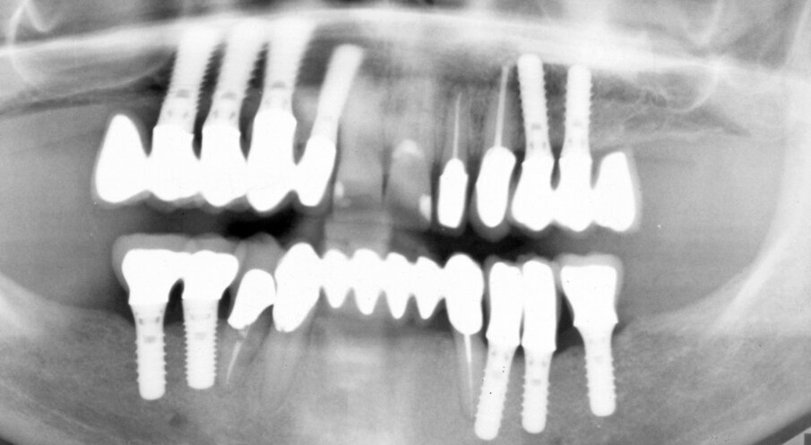Fig. 3. 2nd consultation. Orthopantomograph. After implant placement and prosthetic treatment.