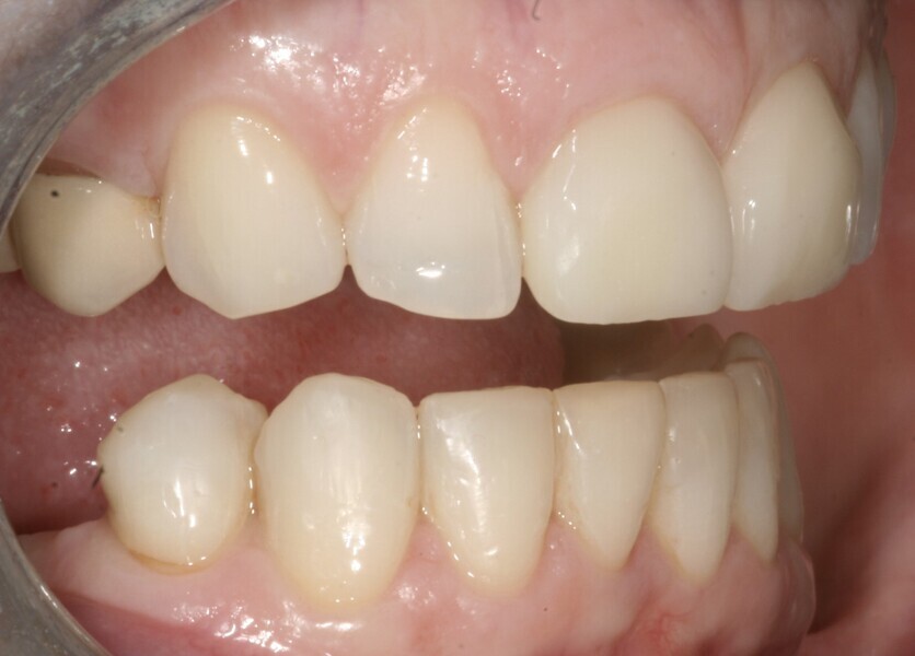 Fig. 8: 2004—lateral view of the new ceramic crown and veneer.