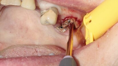 Maxillary first molar atraumatic extraction