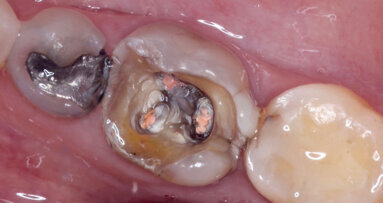 Endocrowns milled from CAD/CAM composites for high strength and flexibility