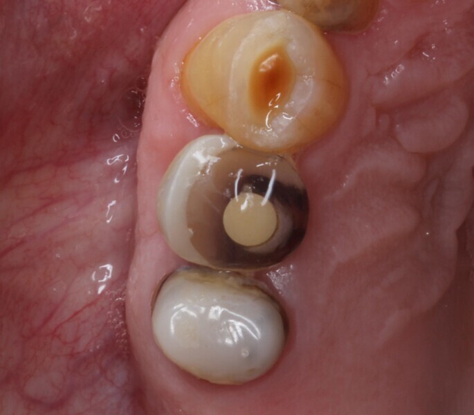 Fig. 20: Situation after four months of healing.