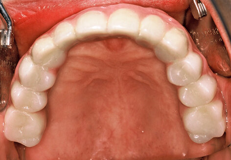 Fig. 14. Final restoration (palatal view).