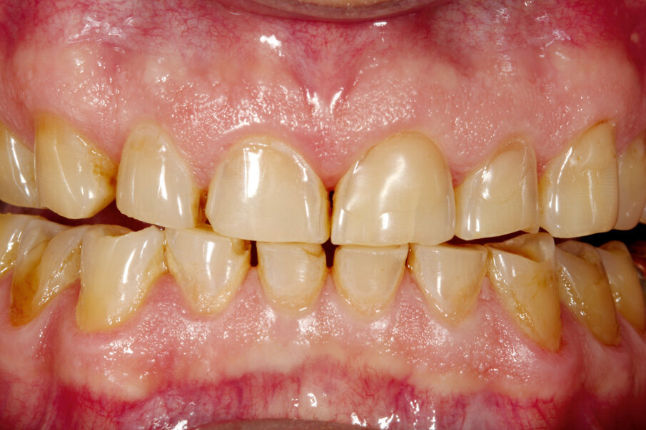 Fig. 2: Pronounced abrasion due to bruxism, resulting in significant loss of the vertical dimension.
