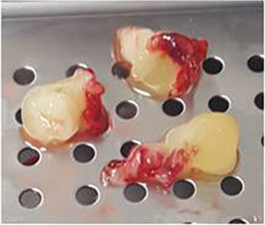 Fig. 4: PRF plugs.