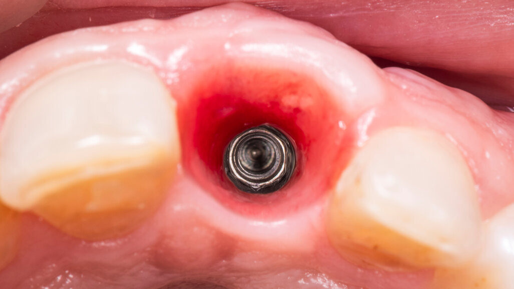 Experts agree on standards for clinical treatment of peri-implant soft tissue