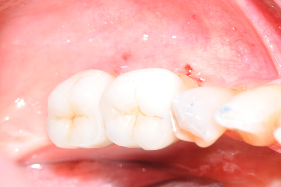 Fig. 10 - Controllo a 3 mesi, aspetto clinico della riabilitazione.