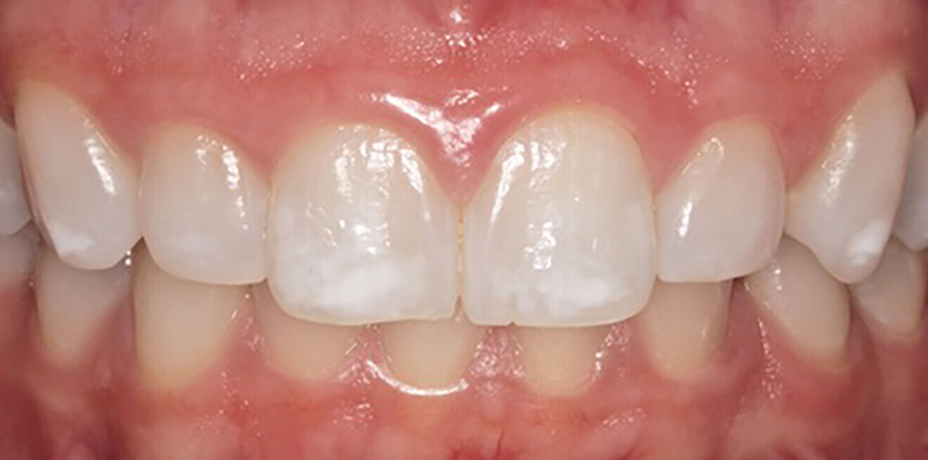 Fig. 1b: Maxillary canine to canine view. After bleaching.