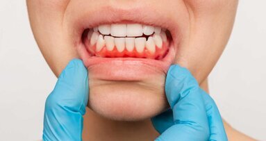 Früherkennung von Gingivitis durch neuen Test