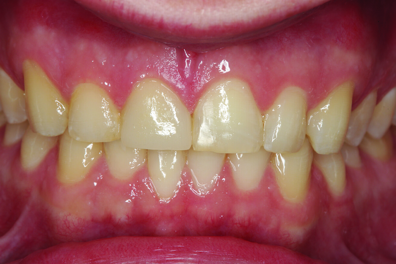 Fig. 17: Six-month post-op retracted facial view of the restored teeth #11 and 41 with the teeth in maximum intercuspation. Aesthetic and functional harmony had been achieved.