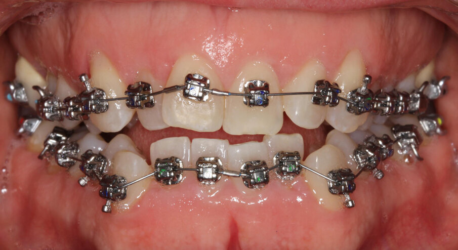 Initial treatment