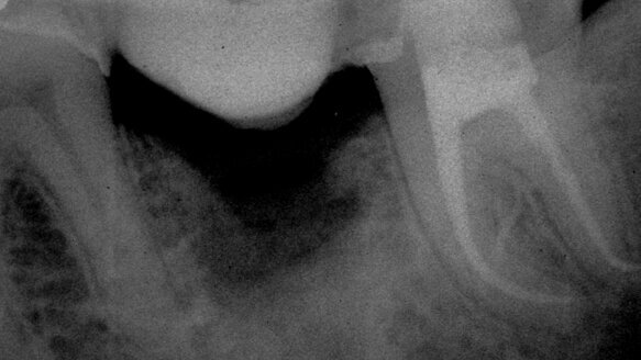 The interrelationships between complex canal anatomy and the instruments that shape them