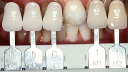 Fig. 2. Mediante la guía VITA Linearguide 3D-MASTER se determinó con precisión el color dental y se pudo seleccionar el correspondiente color de bloque 0M1.