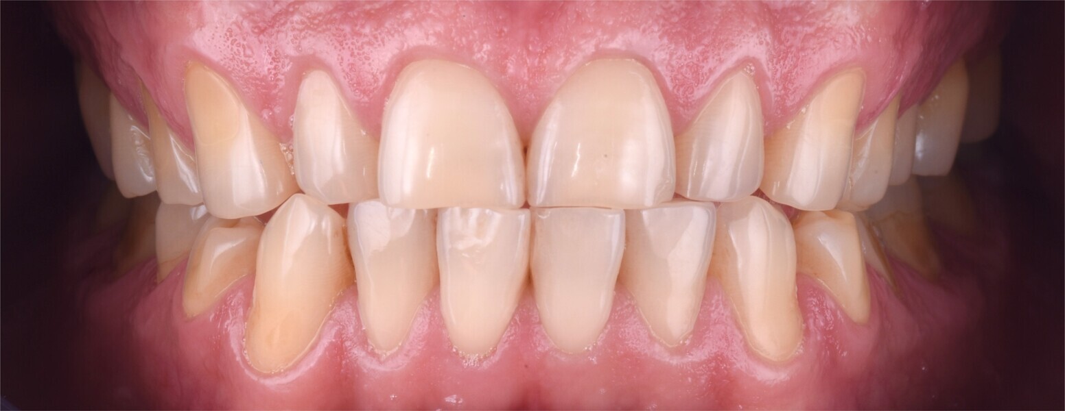 Figs. 2a-e: Initial intra-oral photographs.