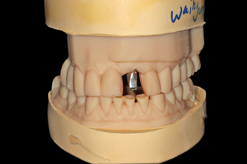 Fig. 16a: The accuracy of the implant and template design allows for true restoratively driven planning combined with CAD/CAM applications for the design
and fabrication of a patient-specific abutment and transitional restoration.