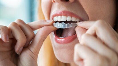Webinar to focus on advanced digital visualisation tools for aligner treatment