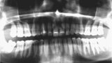 Fig. 2. Situación inicial, radiografía panorámica (2015).