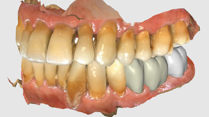Fig. 4: Bridge design using CEREC Software.