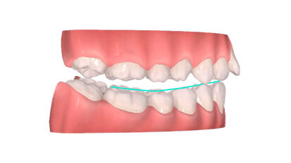 Skeletal and dental Class II, Division I malocclusion solved in 11 months with MTO system: Using Carriere Motion Appliance and clear aligners without extraction