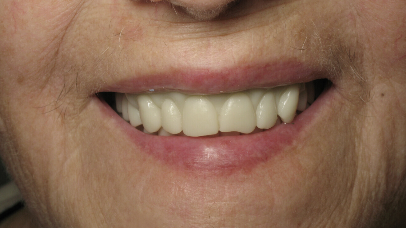 Fig. 10 : Photographie du sourire avec la maquette imprimée en 3D.