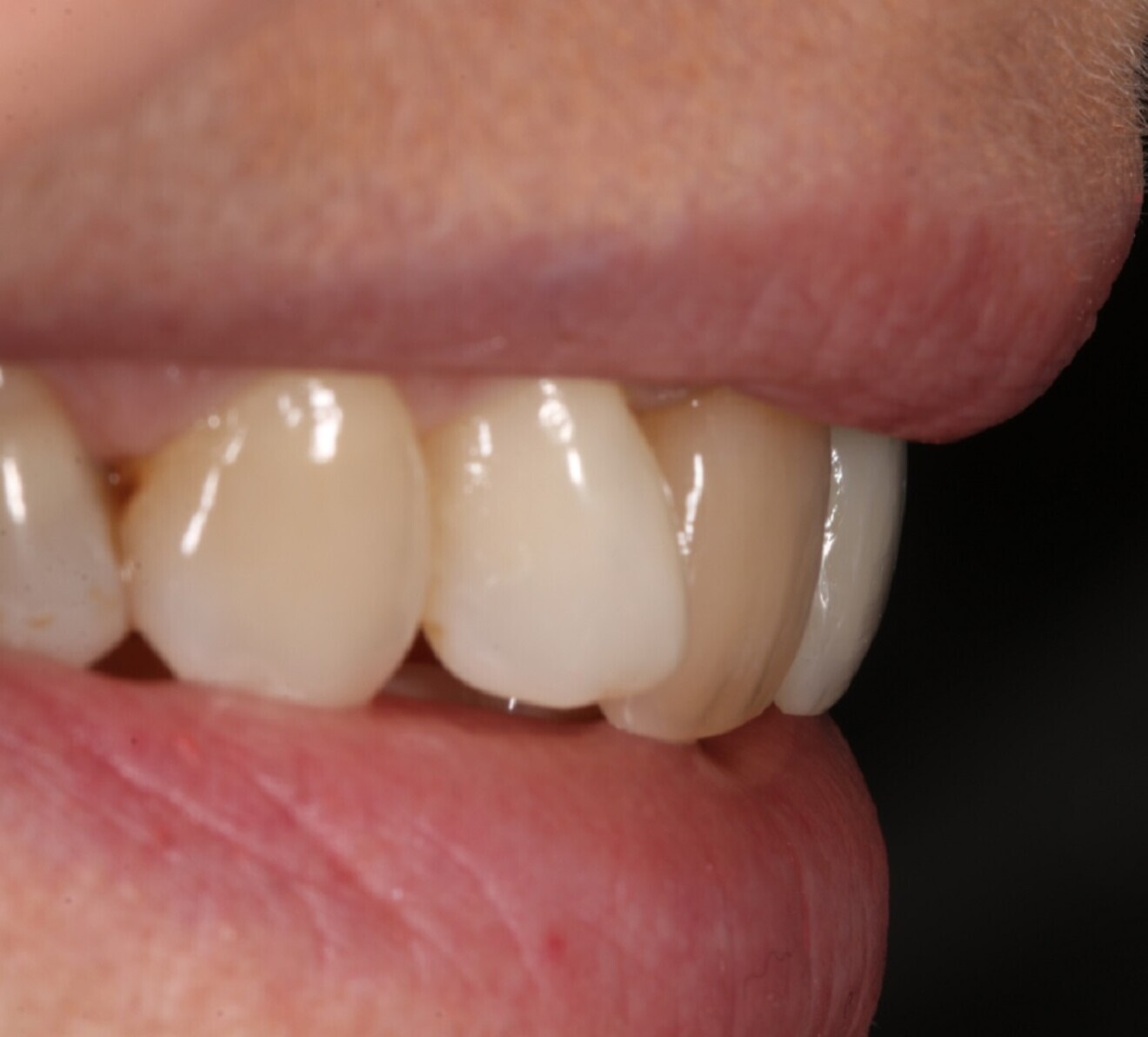 Figs. 4a & b: Smile makeover with porcelain veneers: before (a) ...