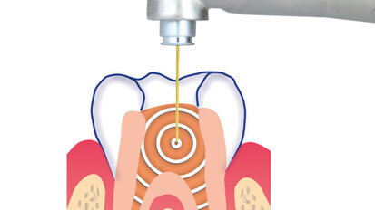 SSP/SWEEPS endodoncie se SkyPulse Er:YAG laserem