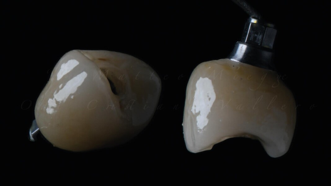 Fig. 6_Corona in zirconia.