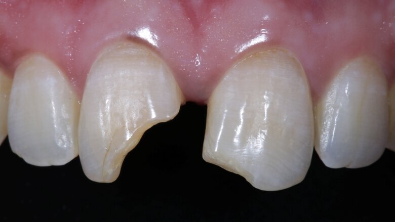 Fig 2 Preop