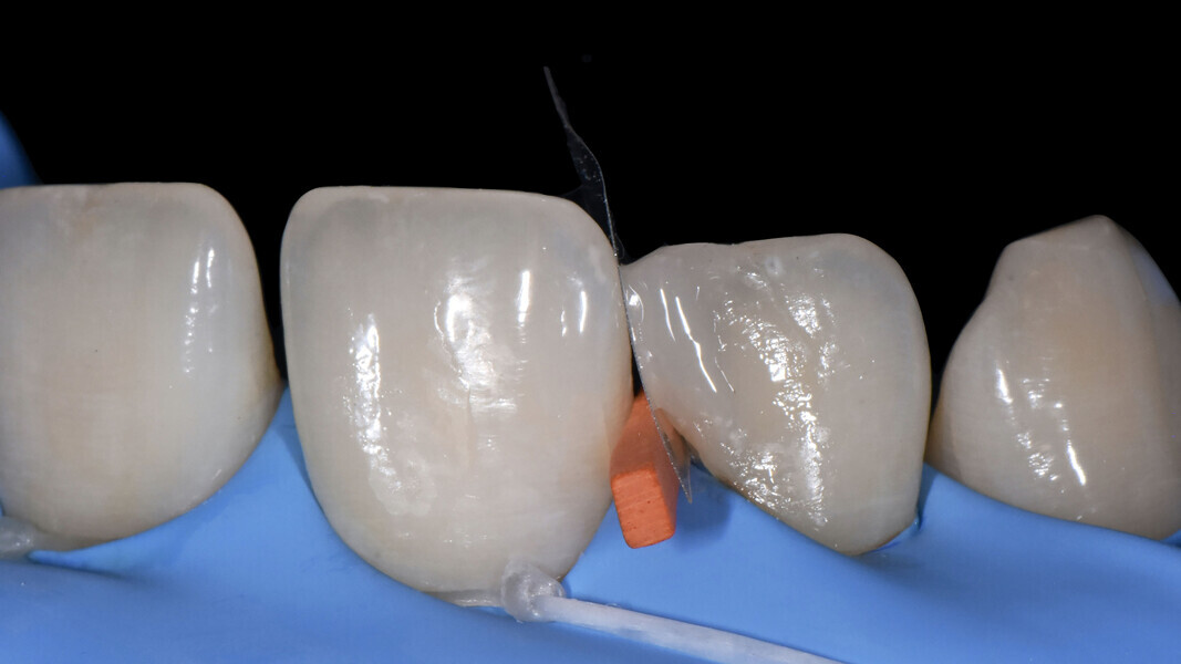 Fig. 9: Gap closure on tooth #12.