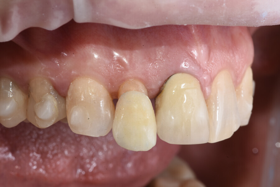 Fig. 11: Placement of the provisional restoration on tooth #12 to maintain the space.