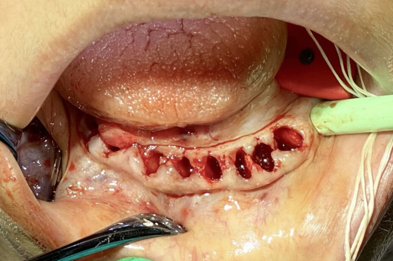 Fig. 11: Mandibular extractions.