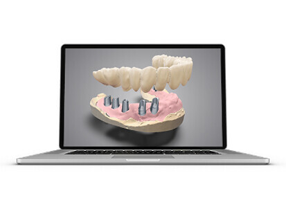 Dental Wings – DWOS Implant Prosthetics