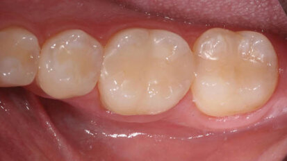 Nanohybrid composite solutions that patients love