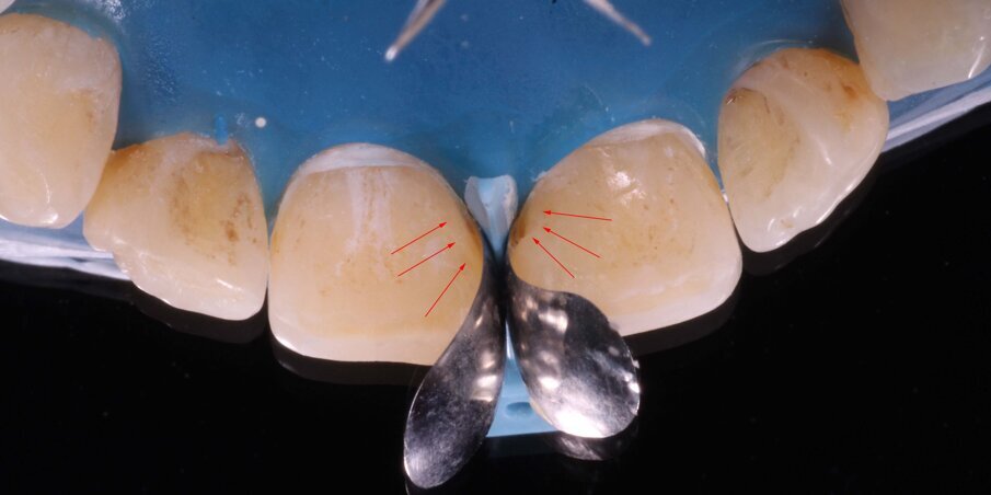 Fig 8. Palatal view showing perfect cervical adaptaion of martices and marked arrows indicating the space to be filled