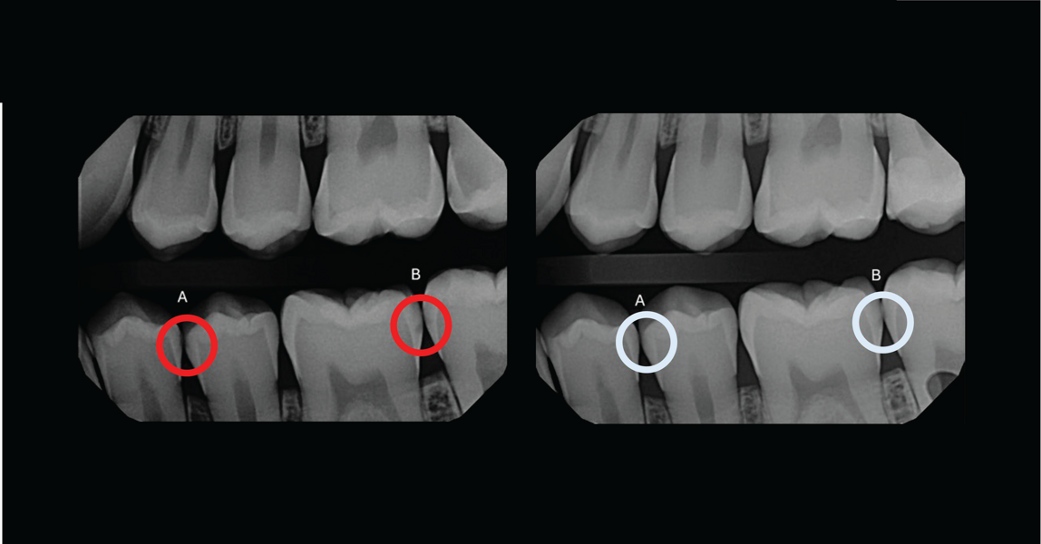 Treatment with Curodont Repair Fluoride Plus: Before (left) and after six months. (Images: Dr. Alisha Gray)