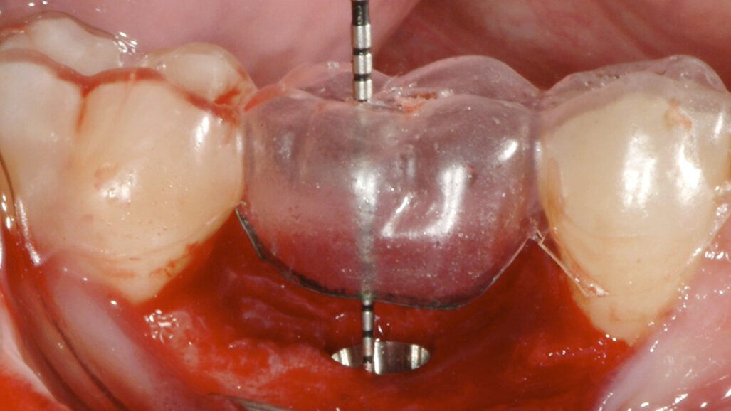 Achieving anatomical shape, support and colour with an Atlantis patient-specific abutment