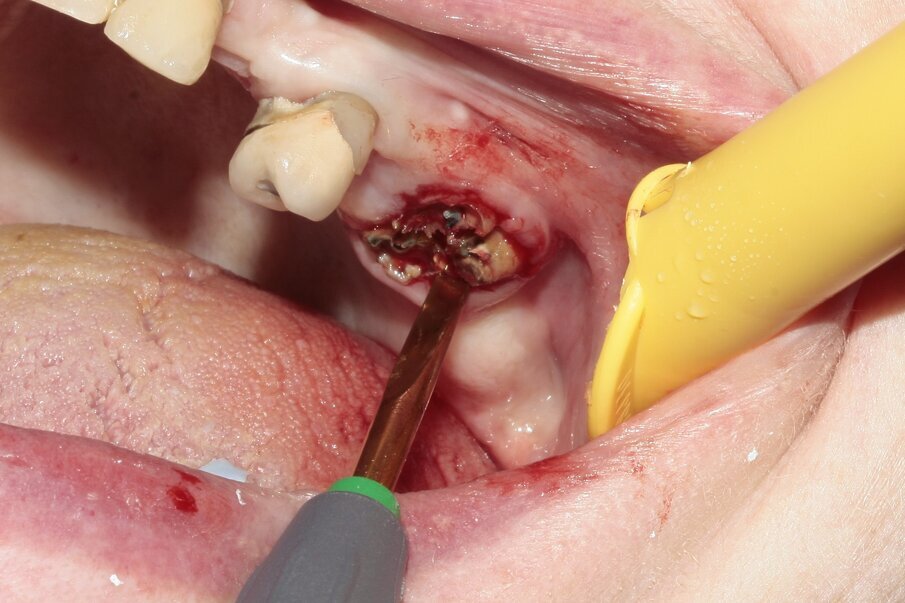 Fig. 6: Continued luxation with Luxator P1 (straight blade, dark green).