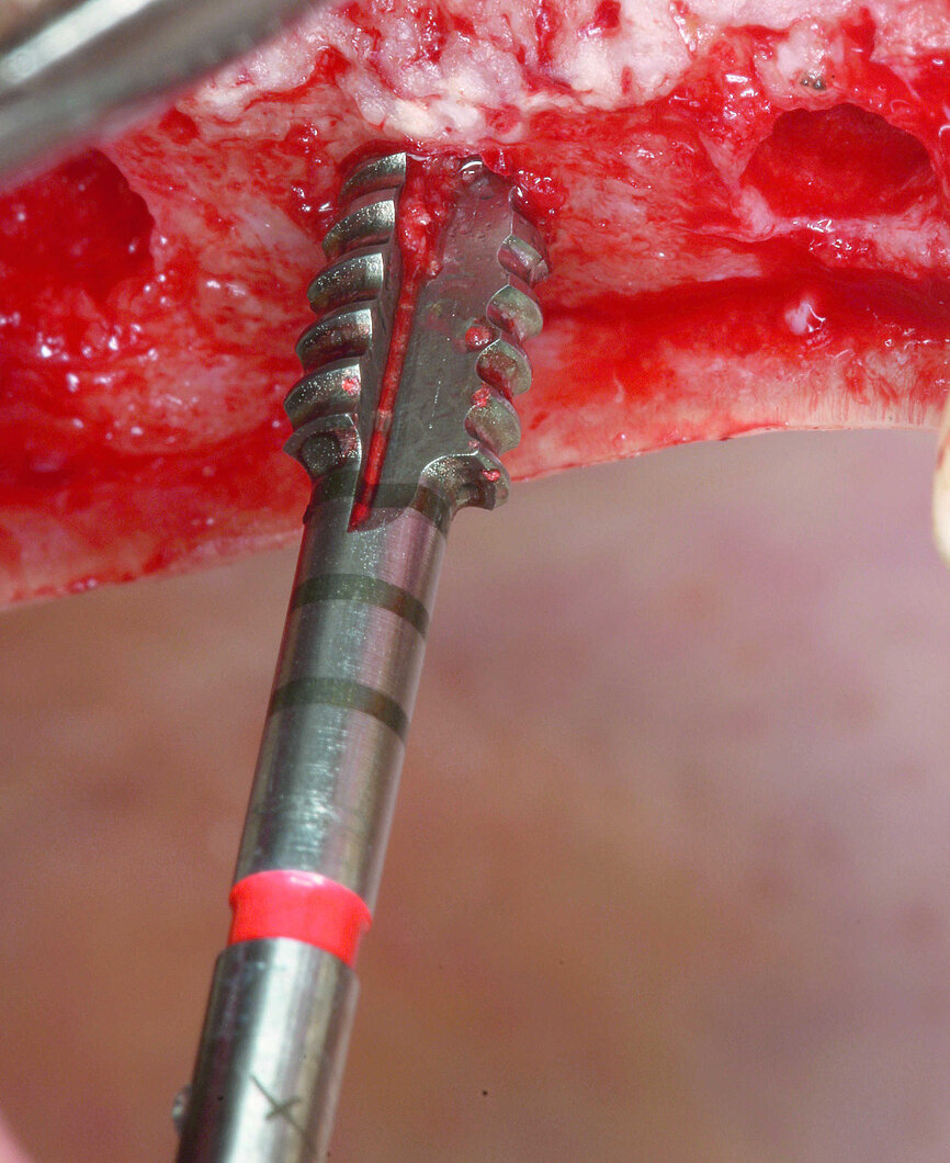 Fig. 12 : Taraudage du filetage. 