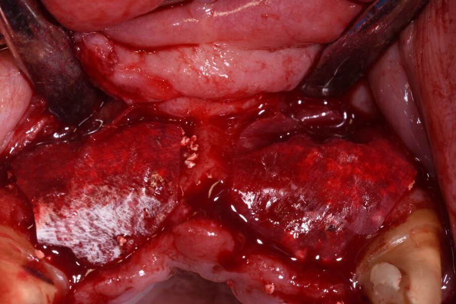 Fig. 23_Per ottimizzare l’azione chirurgica a quella estetica abbiamo progettato una rigenerazione ossea volta ad aumentare il volume vestibolare, utilizzando un sostituto osseo a lento riassorbimento e delle membrane in periostio sottili e riassorbibili fissate con chiodini non riassorbibili.