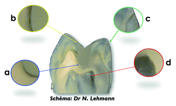 Fig. 6 : Schema illustrant les consequences dentaires liees aux contraintes de polymerisation des resines composites. 