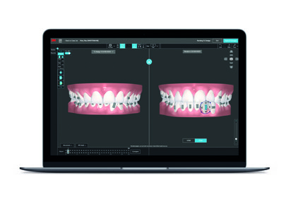 Solventum – 3M Digital Bonding Trays