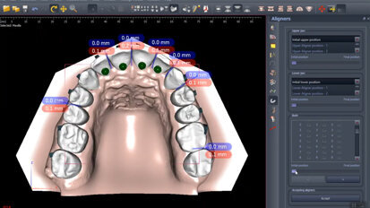 Polorto – DDP-Ortho – Self Control and Acceptance of Aligner Sequences before Lab Procedures