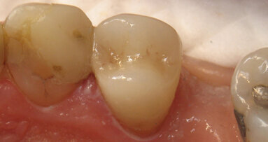 Crown cementation facilitated with the Triodent Griptab restoration handling aid
