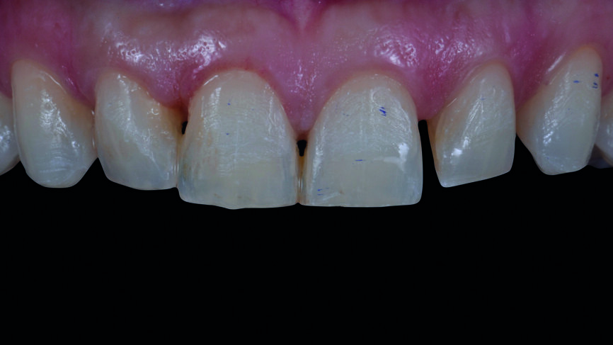 Fig. 7 : Tissu parodontal des dents antérieures six mois après l‘élongation coronaire. 