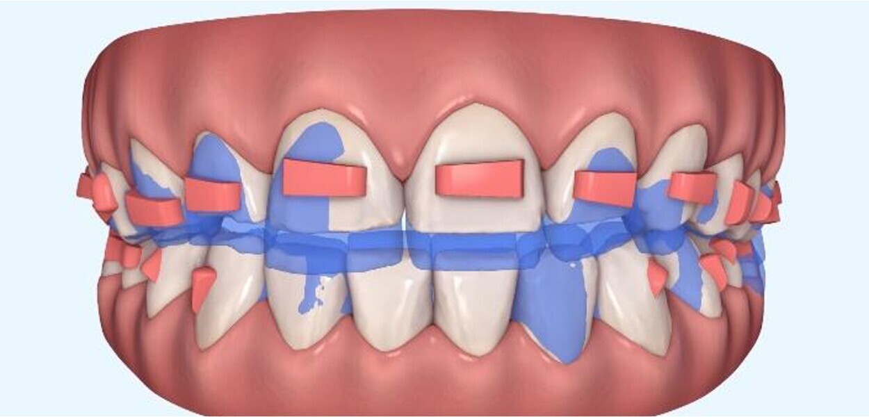 Fig. 4: Orthodontic digital simulation using Invisalign software to show the pretreatment position (blue) and the predicted result after treatment (white).