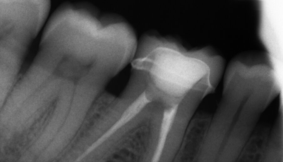Figs. 13a & b: Radiographic control images before and after the treatment.